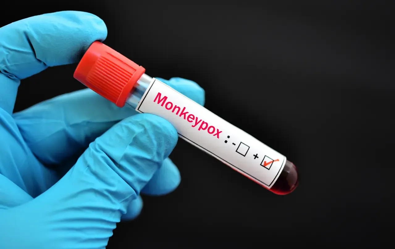 
											
											Маймун чечаги билан касалланганлар сони 20 мингдан ошди
											
											